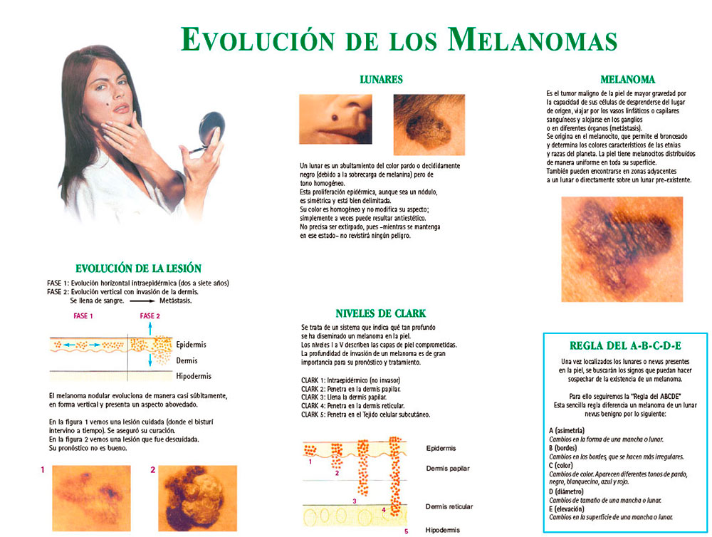 Evolución de los melanomas