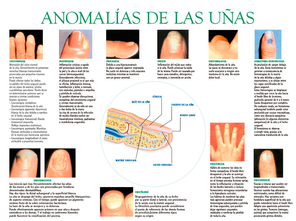 Anomalías de las uñas